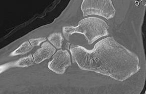 Calcaneum Anterior Process Non Union